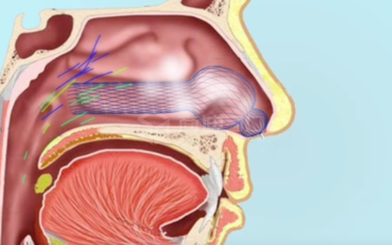 鼻腔支架三维动画演示